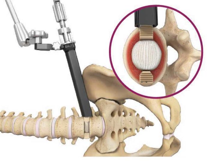 Spineology Duo Angled Instrumentation System
